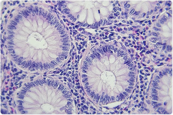 Colon cancer microscopic photography, magnification x400. Image Credit: Lukasz Pawel Szczepanski / Shutterstock