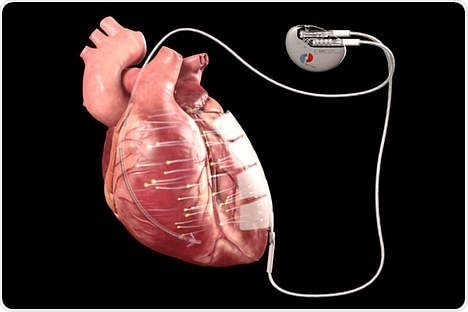 Implanted device uses microcurrent to exercise heart muscle in cardiomyopathy patients