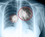 New study helps explain why lung tumors turn aggressive