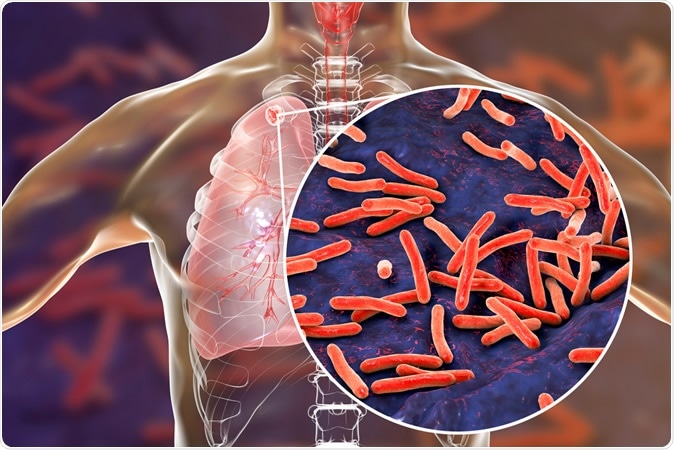 Secondary tuberculosis in lungs and close-up view of Mycobacterium tuberculosis bacteria, 3D illustration Credit: Kateryna Kon / Shutterstock