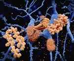 "Australian" genetic mutation provides clues to Alzheimer’s mechanism