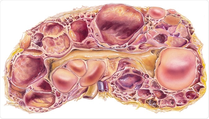 Kidney - Polycystic Disease. Autosomal-dominant polycystic kidney disease, or ADPKD, a disorder passed down through families in which many cysts form in the kidneys, causing them to become enlarged. - Illustration Credit: Medical Art Inc / Shutterstock