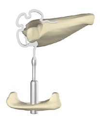 Example of a middle-ear prosthesis: stirrup-prosthesis (NiTiBOND® ): the immobilized stirrup is replaced by a mobile prosthesis. Thanks to the prosthesis, sound transmission is restored and hearing capacity improved.