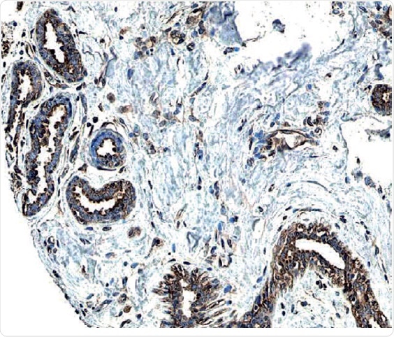ErbB2/Her2 in Human Breast Cancer Tissue