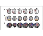 Structural and functional reorganization in the brain predicts language production