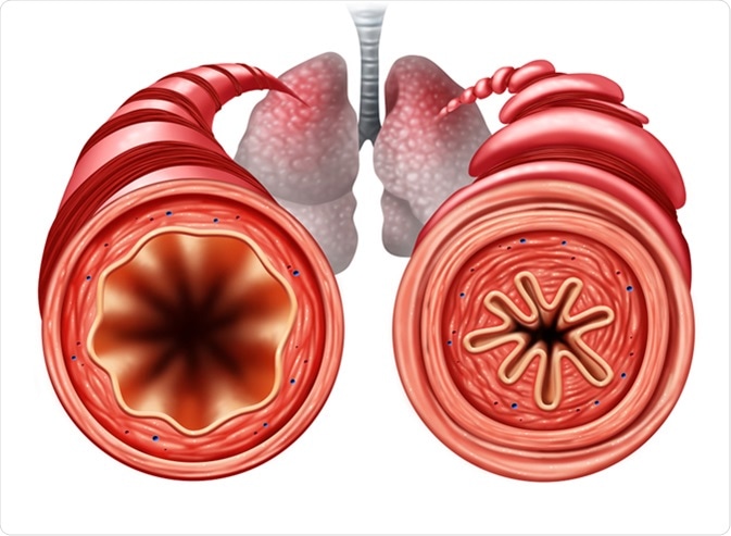 Asthma diagram as a healthy and unhealthy bronchial tube with a constricted breathing problem caused by respiratory muscle tightening. Image Credit: Lightspring / Shutterstock