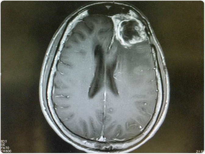 MRI brain show left frontal gliblastoma. Image Credit: O_Akira / Shutterstock