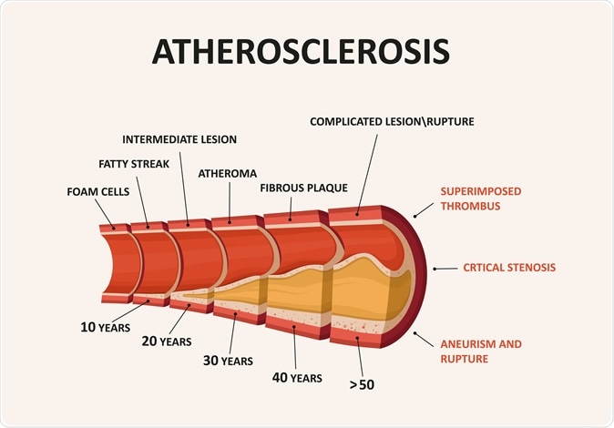 Atherosclerosis - plaque buildup. Image Credit: logika600 / Shutterstock