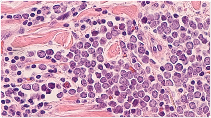 Microscopic image (photomicrograph) of a Merkel cell carcinoma, a highly aggressive type of skin cancer, derived from neuroendocrine cells, typically of the face, head or neck. - Image Credit: David Litman / Shutterstock