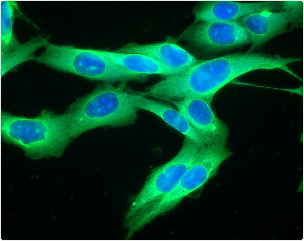 Fluorescently-labeled melanoma cells.