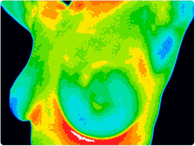 Thermographic image of a chest showing different temperatures from blue showing cold to red showing hot which can indicate inflammation and infection. Image showing healthy breast with no growths. Image Credit: Anita van den Broek / Shutterstock