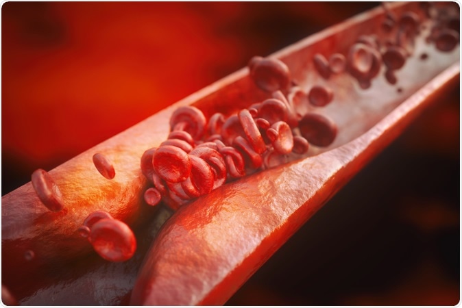 Closeup of a atherosclerosis- 3D rendering - Illustration Credit: Crevis / Shutterstock