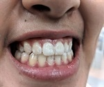 Fluoride varnish: is there any benefit?