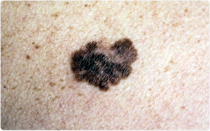 Melanoma - um tumor maligno da pele. Crédito de imagem: Nasekomoe/Shutterstock
