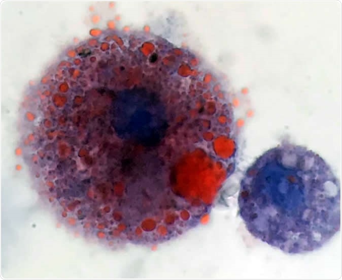 Lipid-laden macrophages found in patients with vaping-related respiratory illness. Oily lipids are stained red. Image Credit: Andrew Hansen, MD, Jordan Valley Medical Center