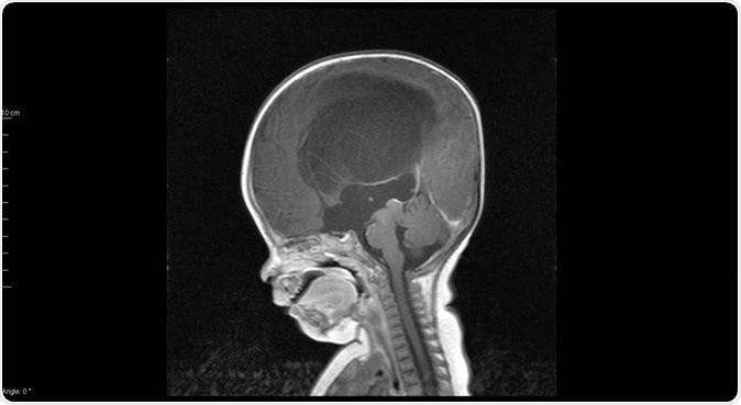 Sagittal MRI T1 showed mark hydrocephalus with congenital aqueductal stenosis - Image Credit: O_Akira / Shutterstock