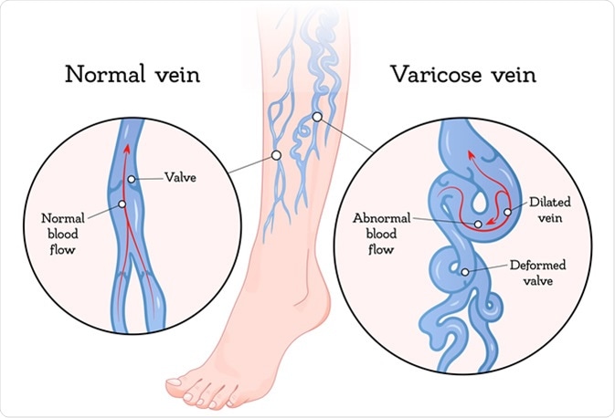 Varicose veins illustration. Illustration Credit: VikiVector / Shutterstock