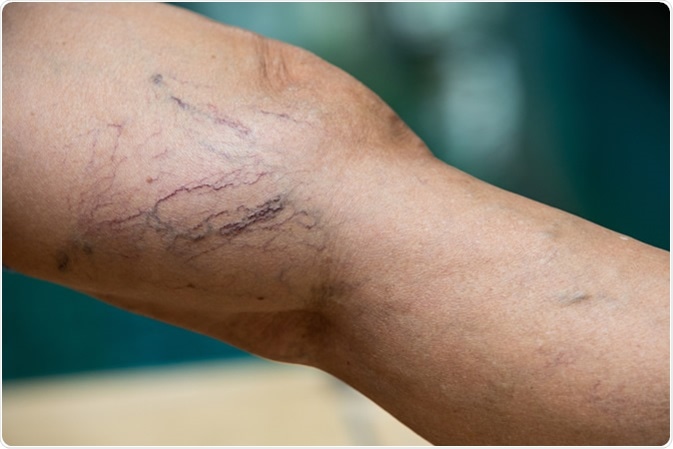 Varicose veins on a leg. Illustration Credit: Eyepark / Shutterstock