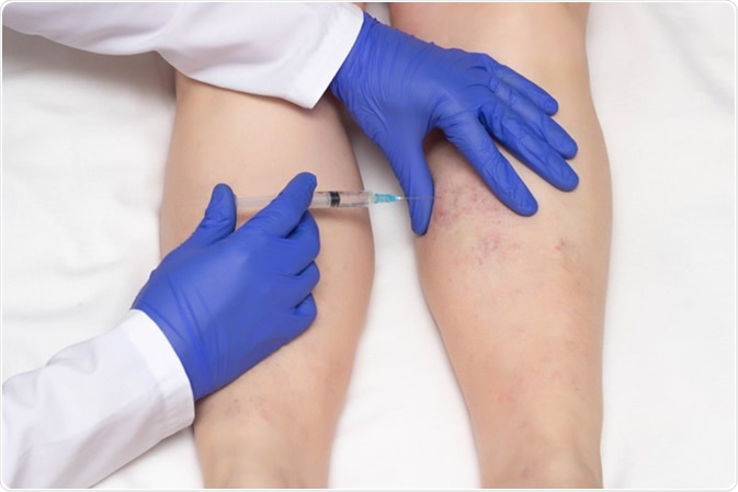 Sclerotherapy procedure on the legs of a woman against varicose veins Credit: HENADZI PECHAN / Shutterstock
