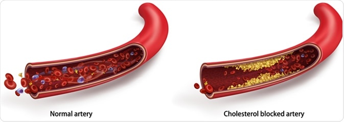 Normal blood flow. The accumulation of cholesterol in the blood vessels. Atherosclerotic plaque. Vector 3d illustration - Illustration Credit: Studiovin / Shutterstock