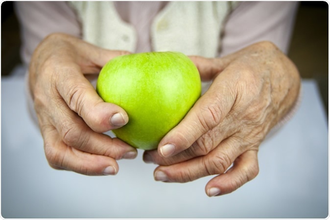 Rheumatoid arthritis in the hands. Image Credit: Hriana / Shutterstock