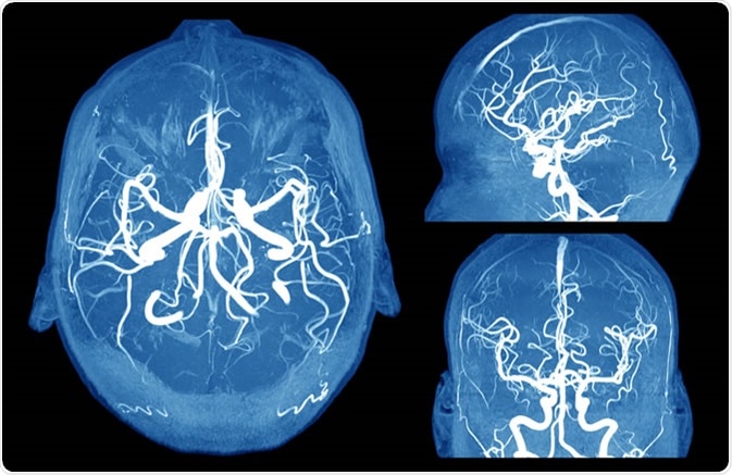 Brain aneurysm MRI. Image Credit: MriMan / Shutterstock