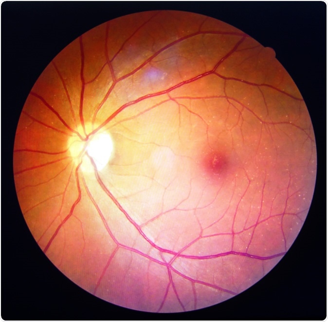 Diabetic retinopathy. Image Credit: Anukool Manoton / Shutterstock