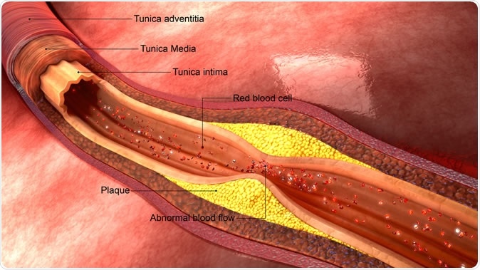 Atherosclerosis 3d illustration Image Credit: Sciencepics / Shutterstock