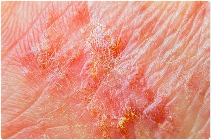 Macro shot of hand eczema. Image Credit: Ana-Maria Tegzes / Shutterstock