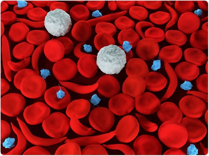 Sickle cell anemia red blood cells - Illustration Credit: Meletios Verras / Shutterstock