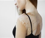 Vitiligo patients have low risk for skin cancer