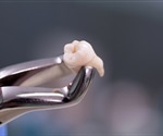 Patients prescribed opioids after dental extraction report higher levels of pain