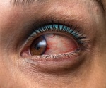 Researchers find a class of drug that could be promising treatment for uveitis