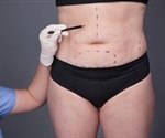 Body contouring surgery is affordable to patients with insurance and income, says researcher