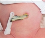 Delayed umbilical cord clamping improves survival of extremely premature infants