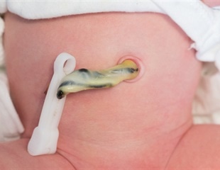 Umbilical cord blood safely and effectively treats children with rare genetic disorders