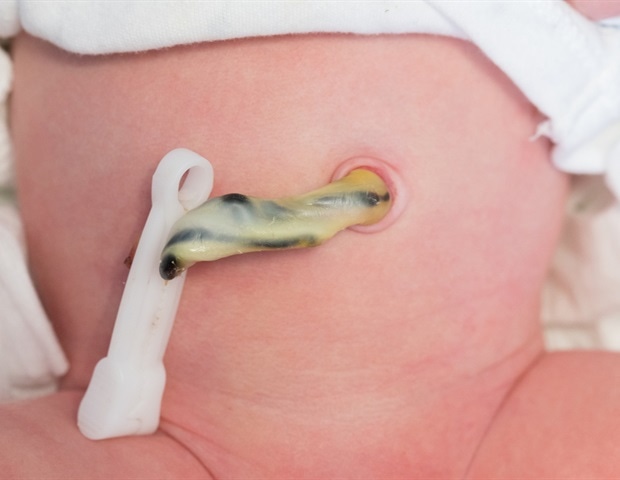 Umbilical cord milking may be safe, more effective for non-vigorous term and near- term infants