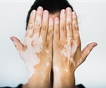 Genetic and environmental factors play major roles in the onset of vitiligo