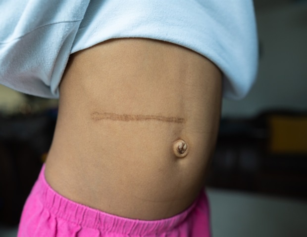 Wilm%27s Tumour Kidney Removal Scar 2 Years Later   Image   Paul30 M1 4967768c48964ce5a07789a27956ccbb 620x480