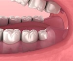 Dental anesthesia appears to affect the development of wisdom tooth