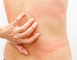 Research reveals key differences between childhood and adult chronic spontaneous urticaria