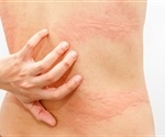 Research shows some COVID-19 patients experience long-lasting skin symptoms