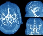 Differences Between an Aneurysm and Migraine