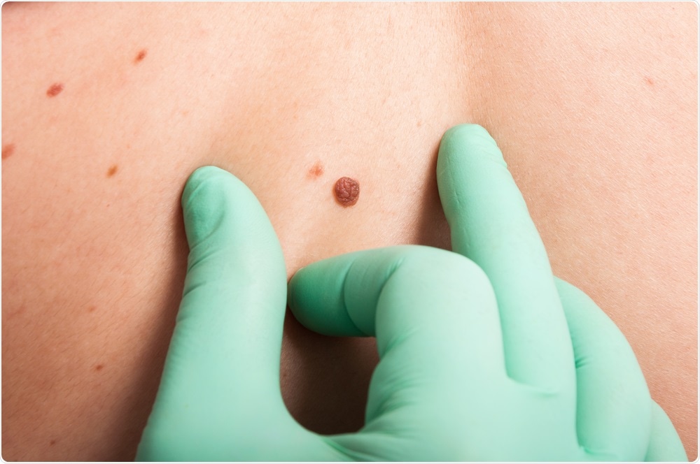 Dermatologist examines mole on person