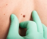 Pioneering melanoma test to be made available within two years