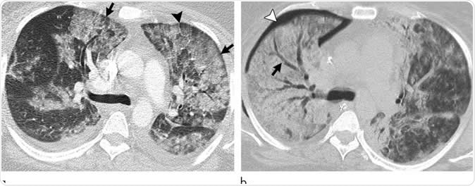 Images show electronic cigarette or vaping product use-associated lung injury with diffuse alveolar damage pattern in a 35-year-old woman who vaped tetrahydrocannabinol. Work-up for infection and rheumatologic disease was negative. (a) Axial CT scan shows ground-glass opacity, left greater than right, with areas of consolidation. Subpleural and perilobular sparing is present (arrows). Septal thickening is present (arrowhead). (b) CT scan 2 weeks later shows extensive right lung consolidation with areas of bronchial dilation (arrow) and internal development of right pneumothorax (arrowhead). Ground-glass opacity in left lung has improved with residual centrilobular nodularity. Patient died 5 days later.  CREDIT Radiological Society of North America