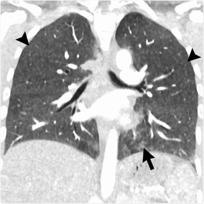 Coronal image shows hypersensitivity pneumonitis (HP) pattern in a 35-year-old man who vaped tetrahydrocannabinol products. Extensive hazy centrilobular nodularity (arrowheads) is most pronounced in midlung and upper lung zones consistent with inhalational injury. Mild ground-glass opacity is present as bases (arrow). This imaging pattern is commonly seen in HP. Patient