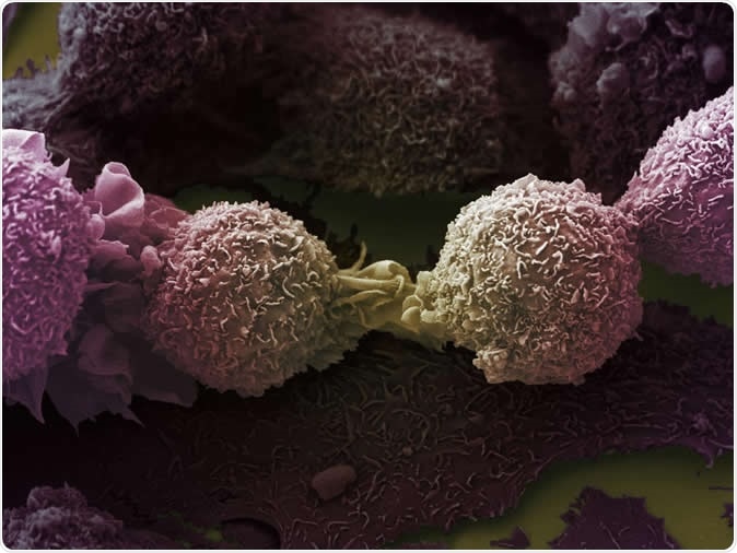 Electron microscopy image of lung cancer cells. Image Credit: LRI EM Unit