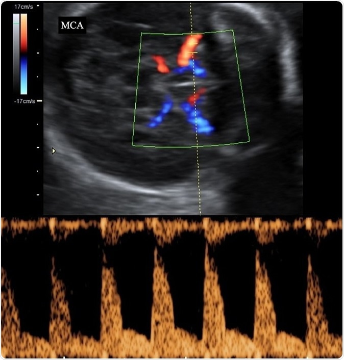 Color Doppler Ultrasound of Fetal Brain (Middle Cerebral Arteries ) Many Other Radiological Images (CT, MRI, PET CT, X-ray) in my portfolio. Image Credit: Springsky / Shutterstock