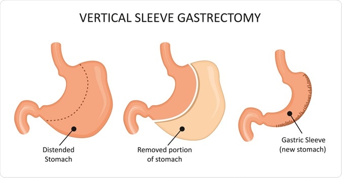 Vertical sleeve gastrectomy. Stomach reduction surgery. Image Credit: logika600 / Shutterstock